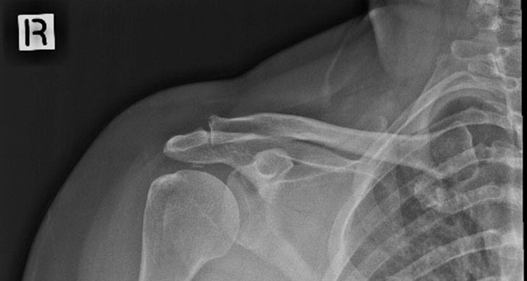 X-ray image of a shoulder